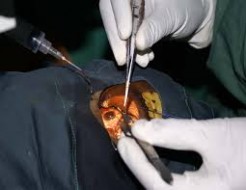 Ferreruela –Sanfeliu / Camp de chirurgie gratuite de la cataracte à Vélingara