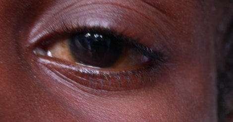 conjonctivite : « Appolo » est de retour