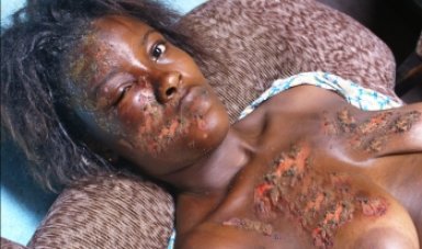 Kolda : une femme ébouillantée décède à Médina Moctar