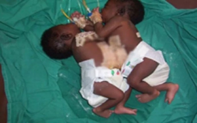 L’Une des sœurs siamoises séparées n’est plus